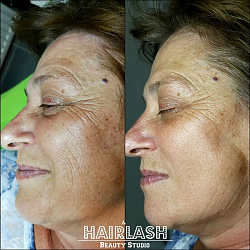 SSR Bőrrejuvenáció - Ráncok és pigmentfoltok enyhülése és egységesebb élettel telibb arcbőr egyetlen 1 kezelés után!